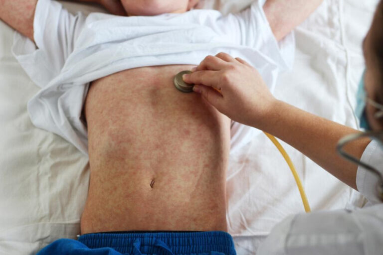 VI Health Commissioner Urges Parents to Vaccinate Children Against Measles